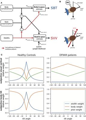 Psychophysical Evaluation of Sensory Reweighting in Bilateral Vestibulopathy